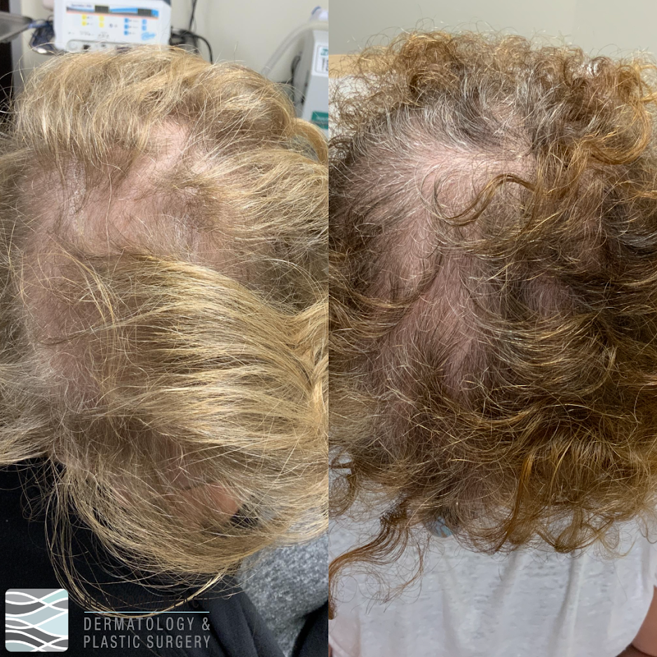 New Year, New Hair! PRP Hair: A great in-office procedural option for hair loss - Kristin Scord, PA-C