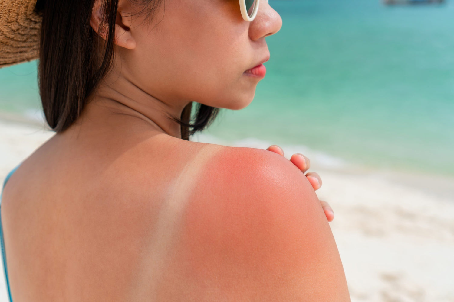 Sunburned skin on shoulder of a woman because of not using cream