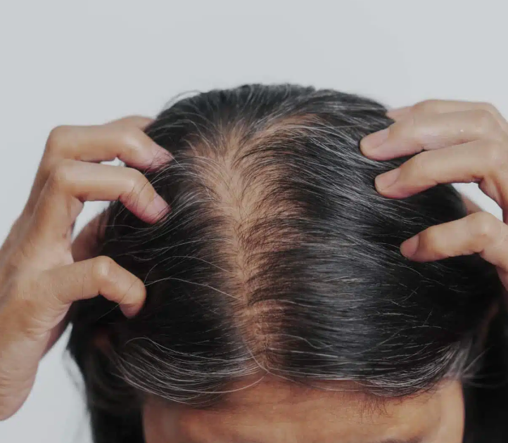 Minoxidil: Everything You Need to Know About Oral and Topical Minoxidil