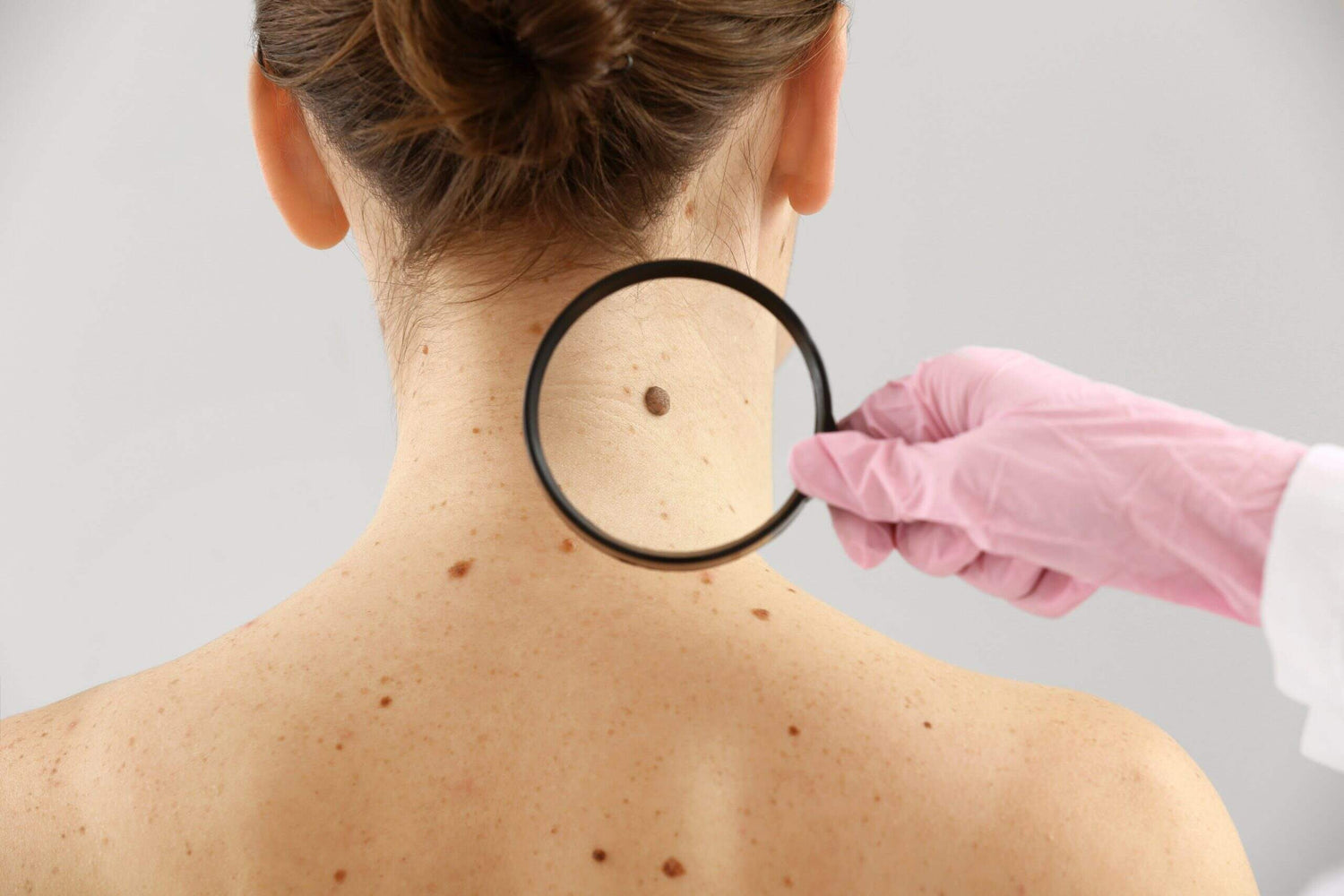 Skin-Cancer-Screening-scaled
