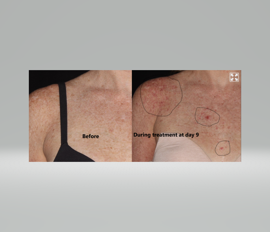 flourouracil before and during