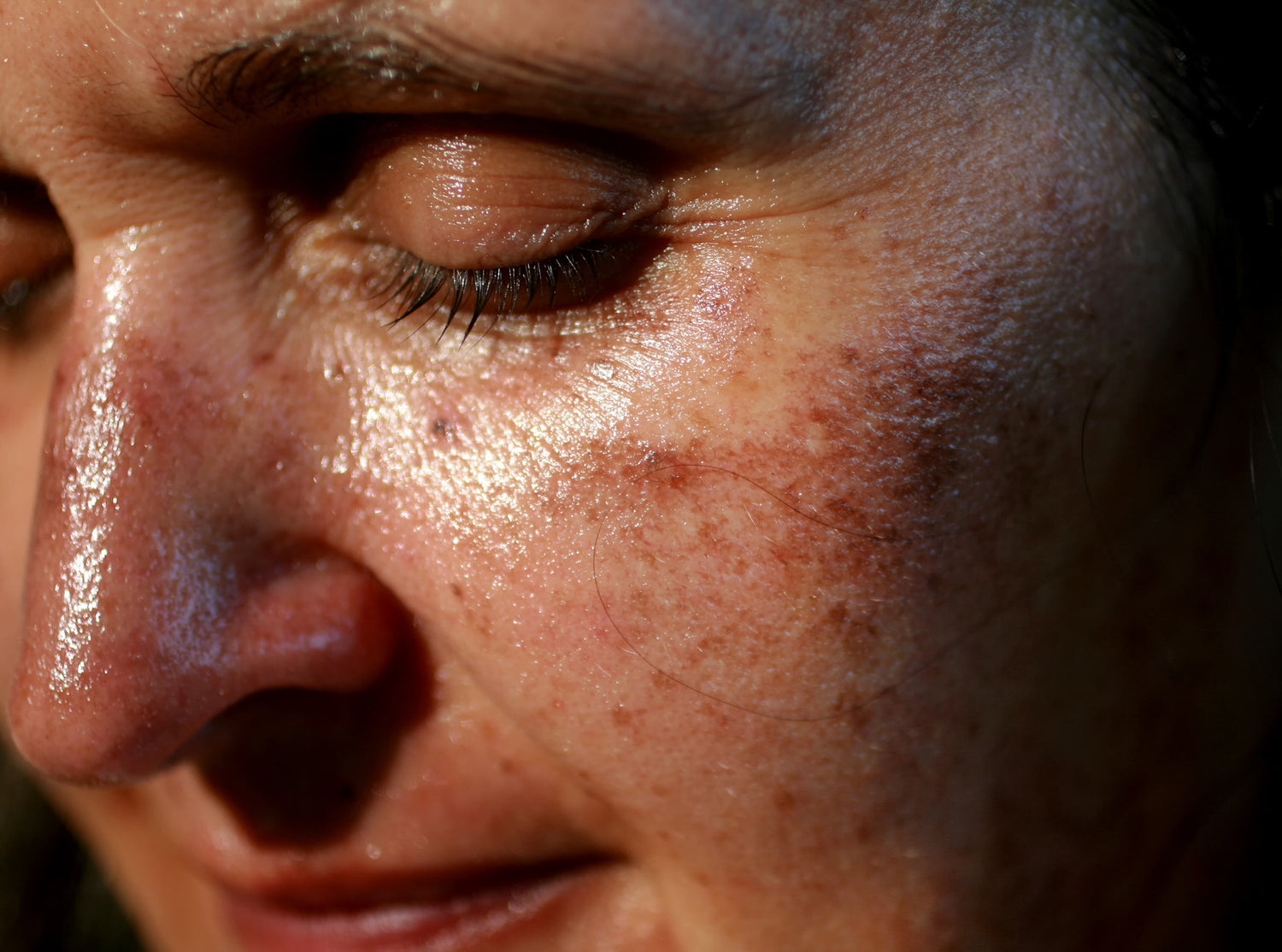 Pigmented spots on the face. Pigmentation on cheeks