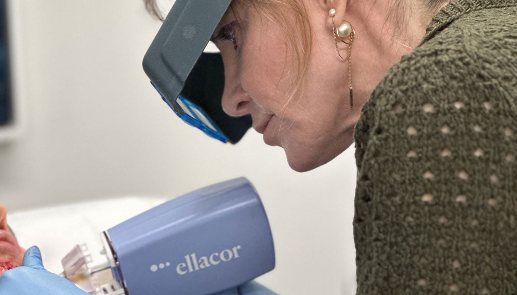 Ellacor Skin Microcoring for Jowls and Perioral Wrinkles