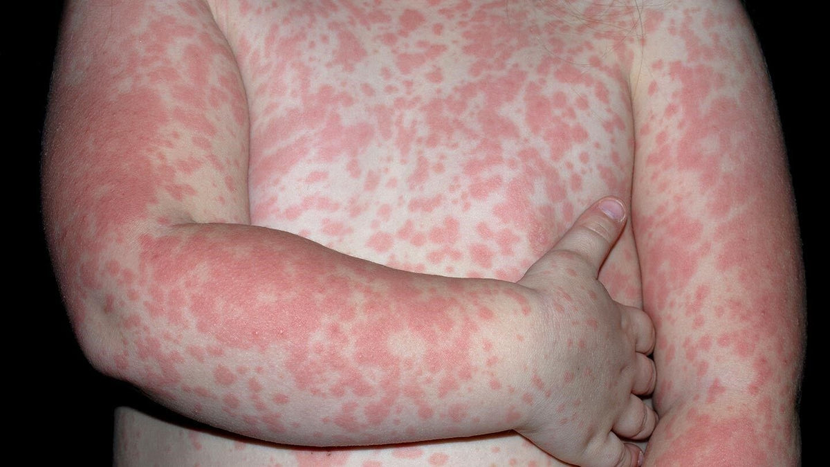 skin rash