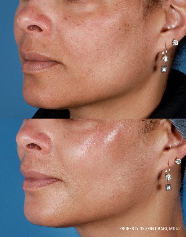 zo 3 step peel blog