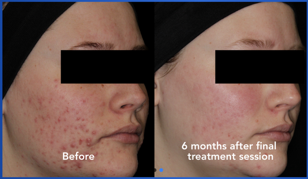See the visible improvement in acne after AviClear laser treatments. *Results may vary.