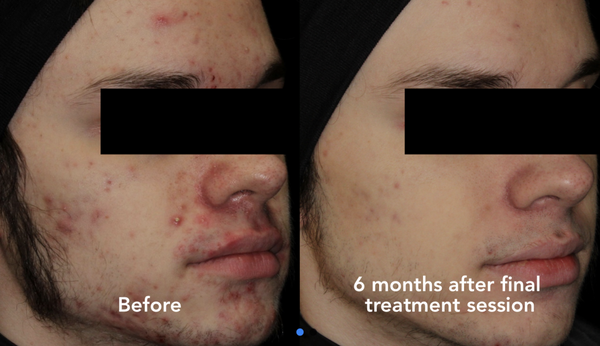 Before and After AviClear