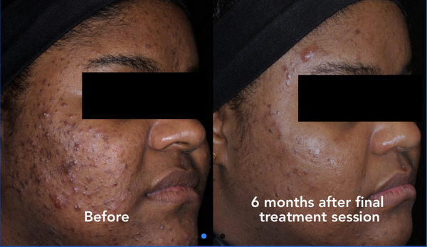 AviClear targets the oil glands responsible for acne, helping reduce breakouts and improve overall skin clarity.