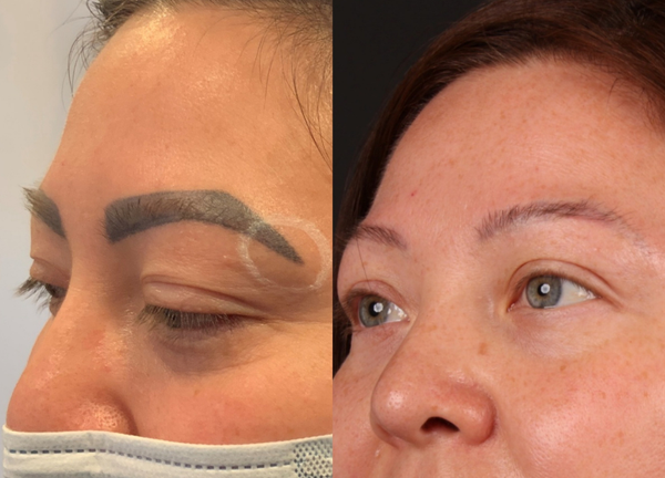  Before and After Microbladed Brow Removal