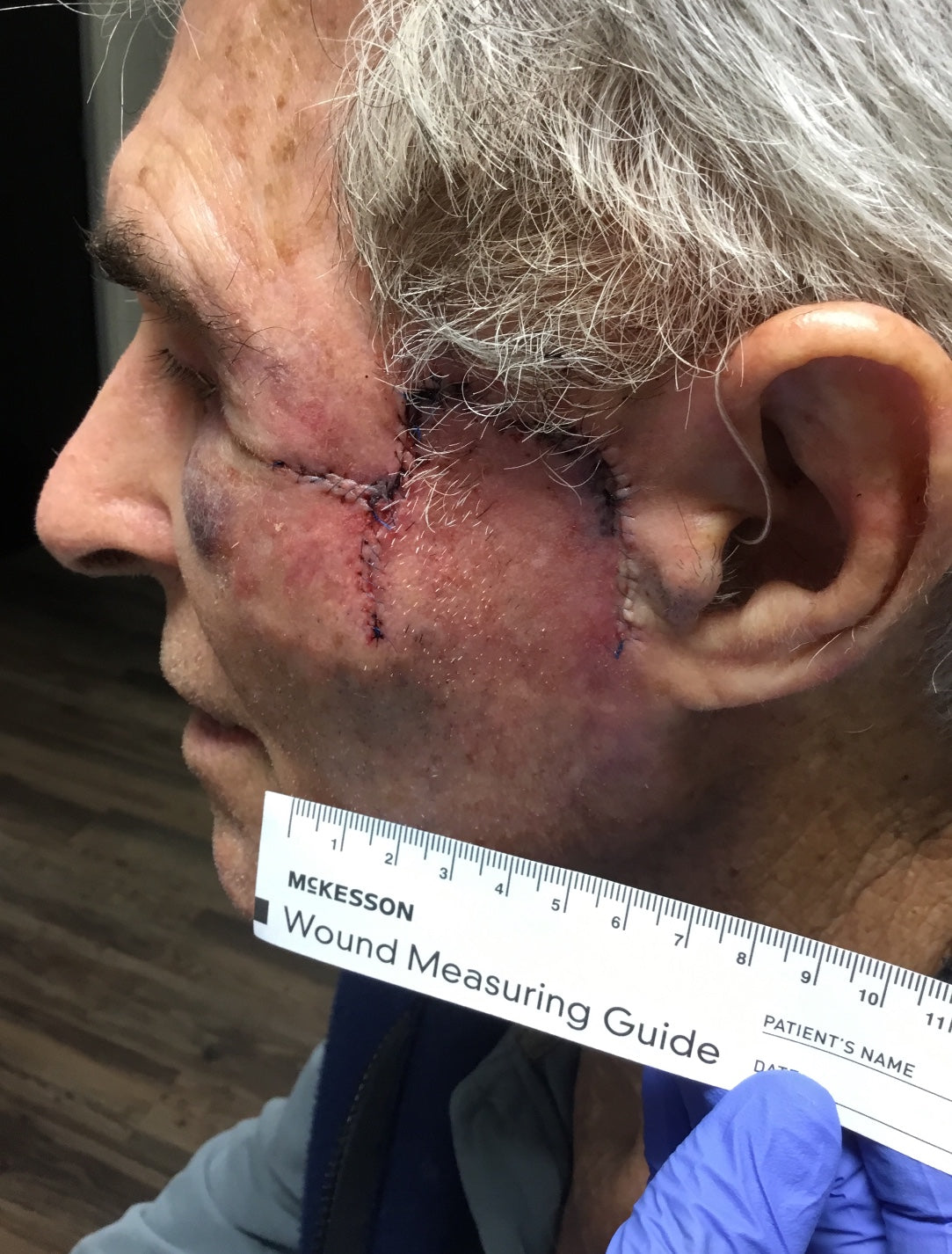 Mohs Surgery and Reconstruction | With Plastic Surgeon, Christopher Ellstrom