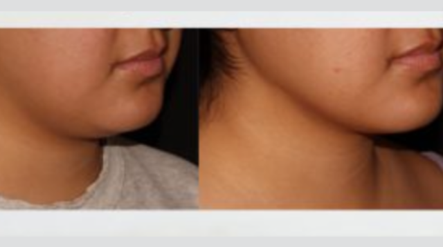 LipoShaping