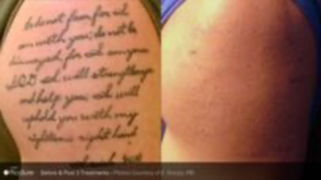 PicoSure ® Tattoo Removal