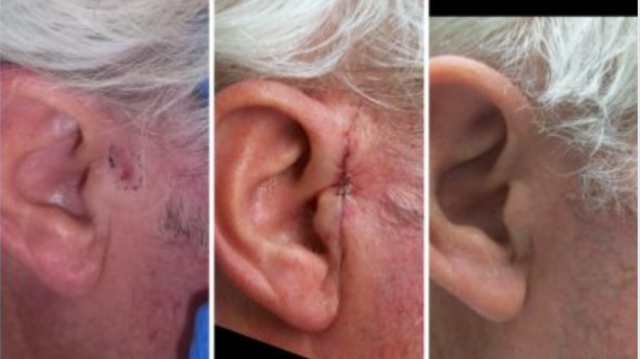 Mohs Surgery and Reconstruction | With Plastic Surgeon, Christopher Ellstrom