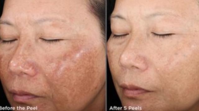 VI Peel ® | Illuminize, Vitalize and Rejuvenize Chemical Peels