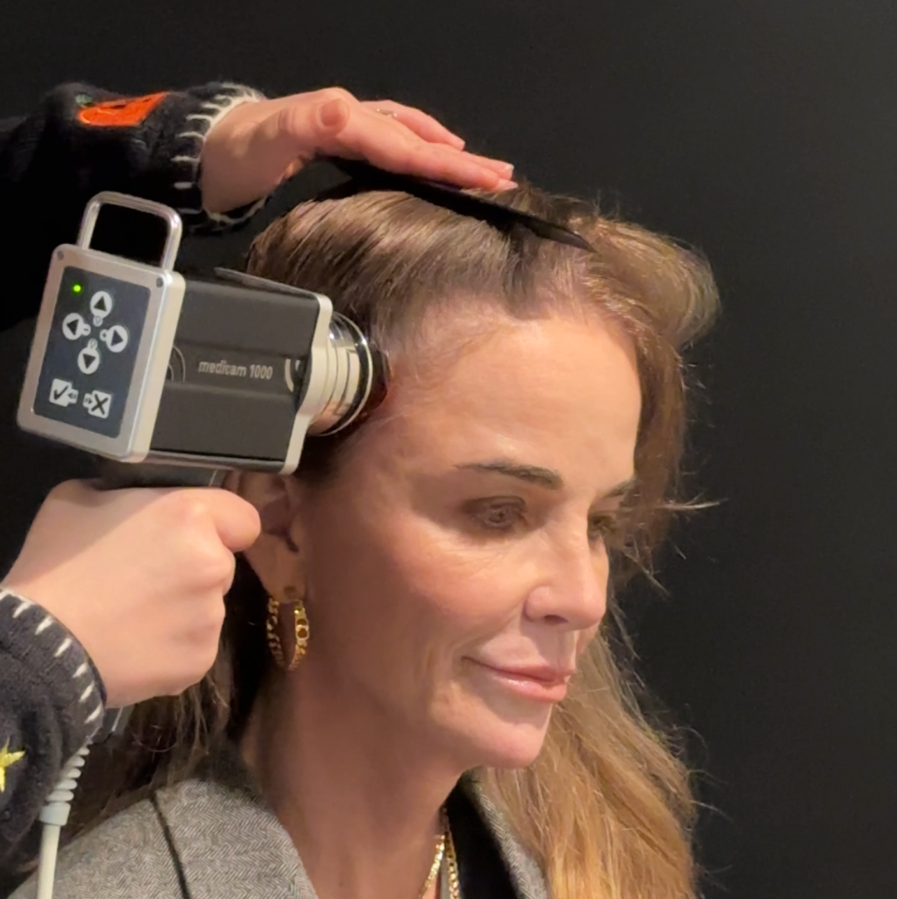 Hair Loss