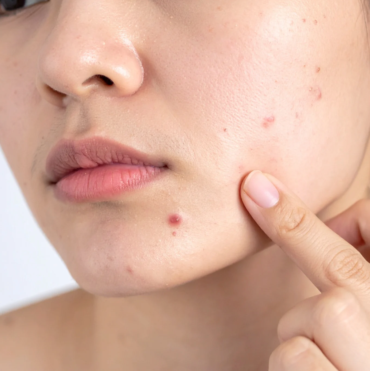 Acne and Rosacea