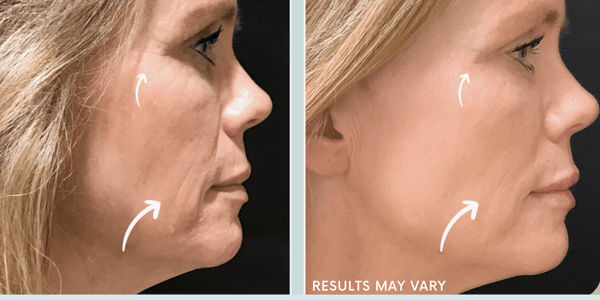 See the visible improvement in skin firmness and smoothness after SofWave treatment. *Results may vary.