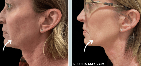 Before and after comparison of a woman's face with visible skin texture differences.