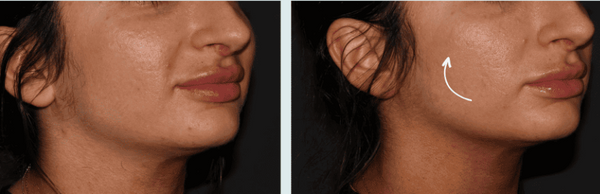 SofWave skin tightening can help improve the appearance of fine lines and mild skin laxity on the face and neck for a more youthful look.