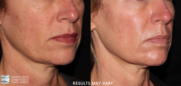 See the visible improvement in skin texture and tone after CO2 laser resurfacing treatments. *Results may vary.
