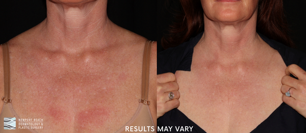 CO2 laser resurfacing helps reduce wrinkles, acne scars, and sun damage while revealing smoother, healthier-looking skin.
