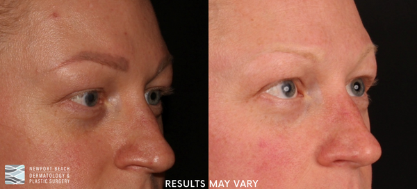See the gradual fading of unwanted eyebrow pigment after microbladed brow removal treatments. *Results may vary.