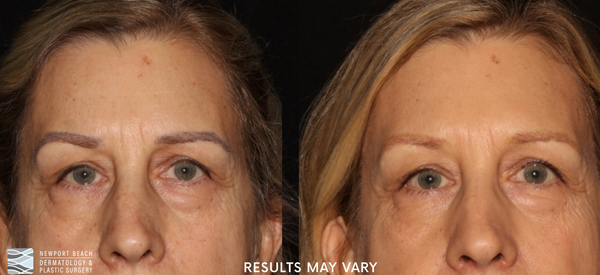 Microbladed brow removal helps lighten or remove unwanted pigment, restoring a more natural appearance to the brows.
