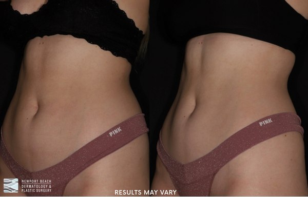  Before and After truSculpt® flex  