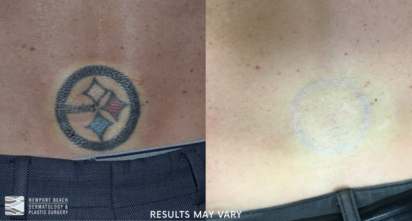  PicoSure laser tattoo removal helps break down tattoo ink so the body can naturally eliminate the pigment over time, leaving the skin clearer with each session.
