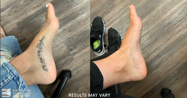 Before and After PicoSure Tattoo Removal 