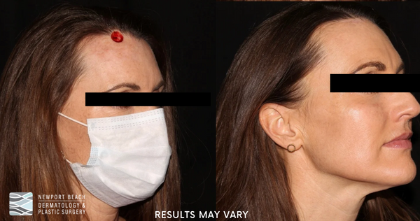 Before and After Mohs Surgery