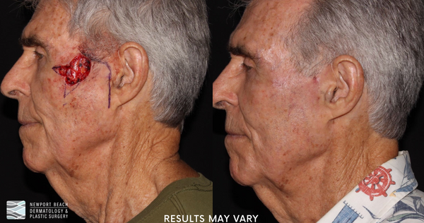 See the successful removal and reconstruction of skin cancer after Mohs micrographic surgery. *Results may vary.