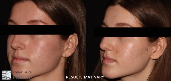 See the visible improvement in skin texture and tone after microneedling treatments. *Results may vary.