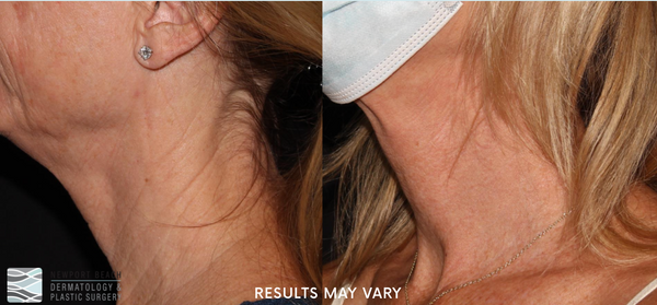 Before and After Microneedling
