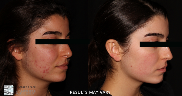 Microneedling helps stimulate collagen production to reduce wrinkles, acne scars, and enlarged pores while improving overall skin quality.