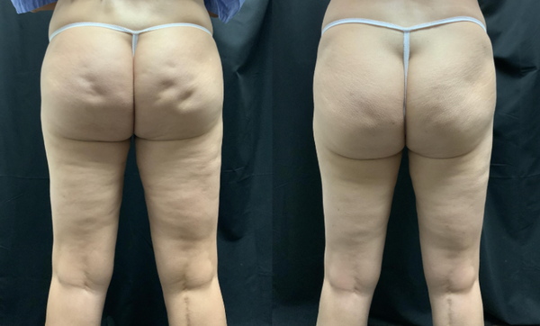 Before and After Cellfina