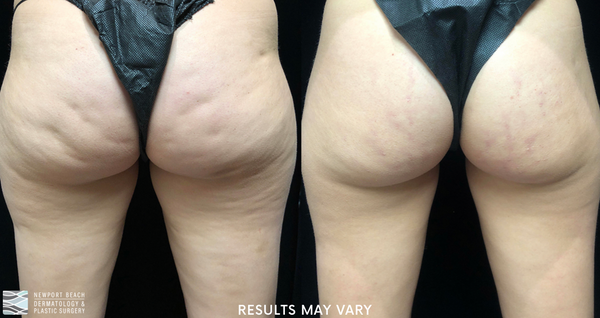 Cellfina targets the structural cause of cellulite to create smoother, more even-looking skin with long-lasting results.