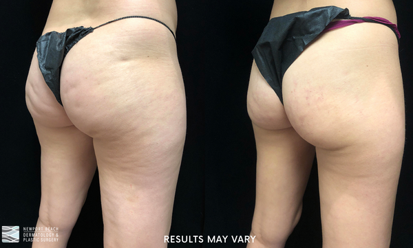 See the visible smoothing of cellulite after Cellfina treatment. *Results may vary.