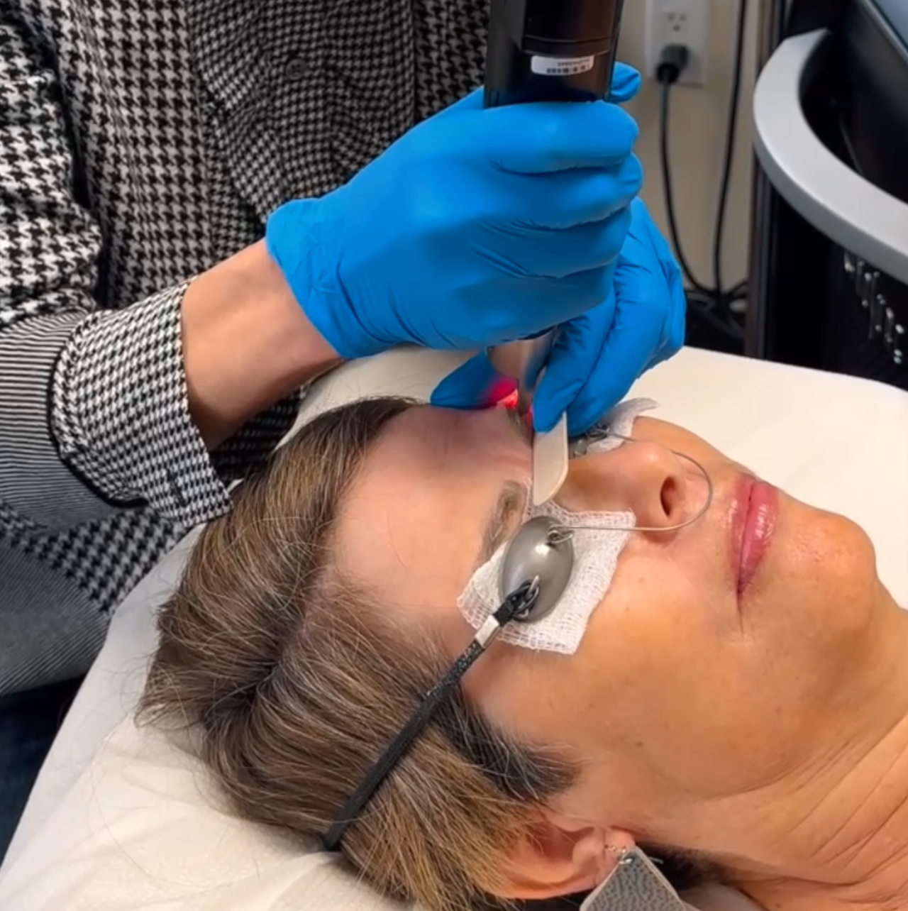 Laser Removal of Microbladed Eyebrows