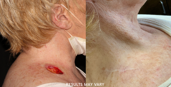 Before and After Mohs Micrographic Surgery 
