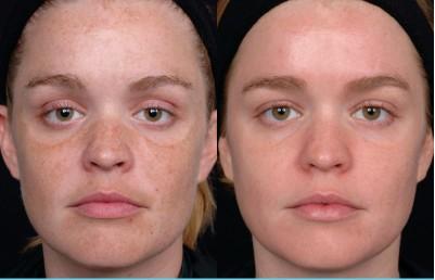 VI Peel ® | Illuminize, Vitalize and Rejuvenize Chemical Peels