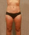 LipoShaping