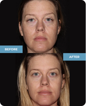 See the center pigmented lesion disappear? *Results may vary.