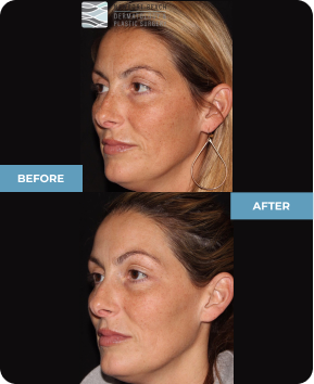 PicoSure laser skin revitalization can help your face, neck arms and legs look younger! 