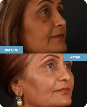 Before and after Picsure