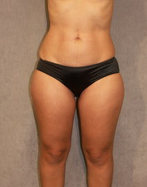 LipoShaping