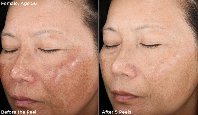 VI Peel ® | Illuminize, Vitalize and Rejuvenize Chemical Peels