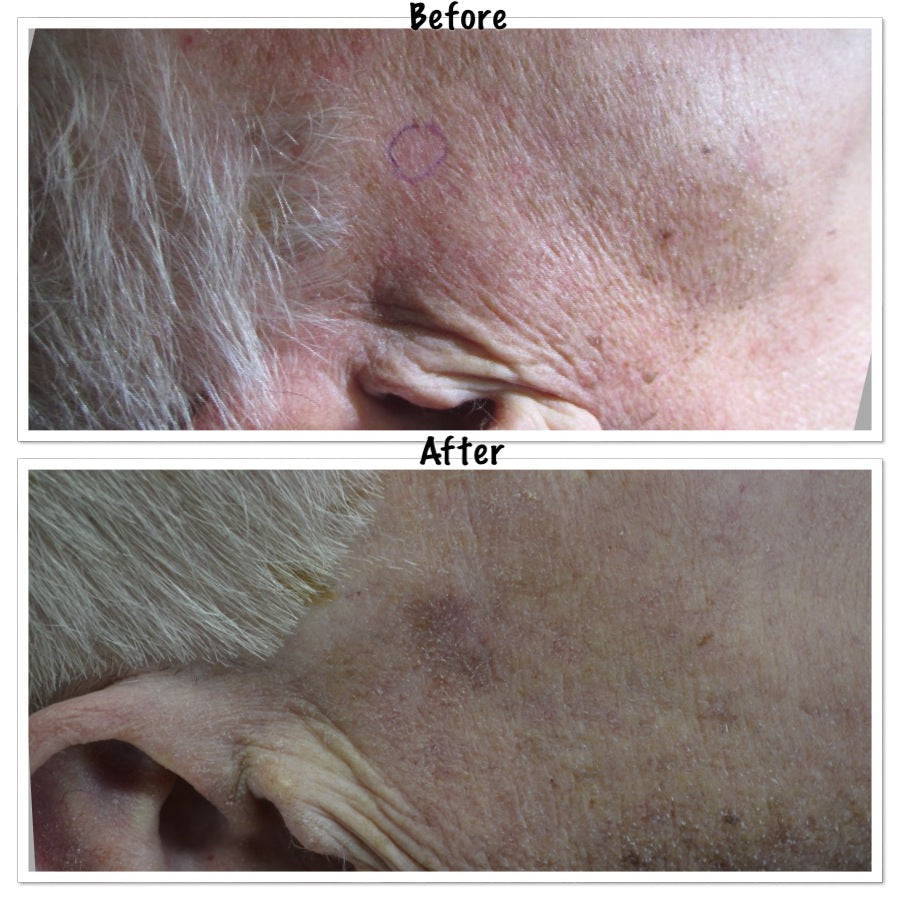 Mohs Surgery and Reconstruction | With Plastic Surgeon, Christopher Ellstrom