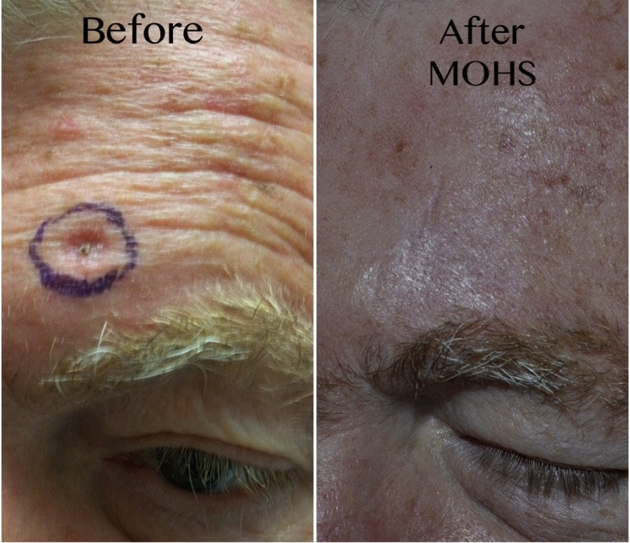 Mohs Surgery and Reconstruction | With Plastic Surgeon, Christopher Ellstrom