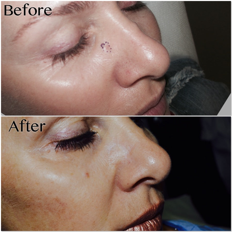 Mohs Surgery and Reconstruction | With Plastic Surgeon, Christopher Ellstrom